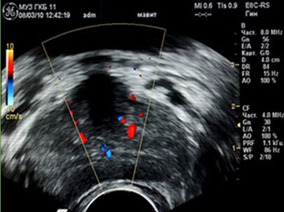 Ultrasound shows a focus of inflammation in the prostate