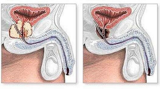 Before and after the treatment of chronic surgical prostatitis
