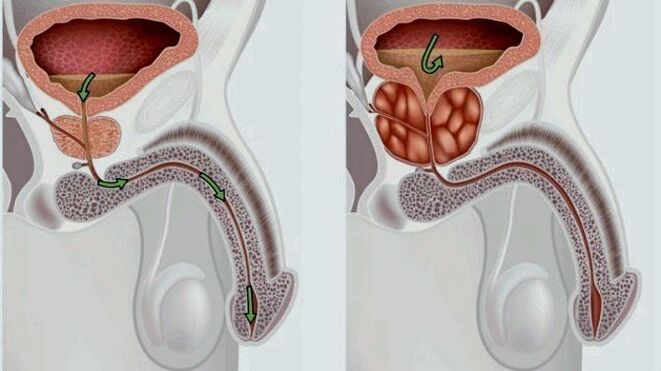 healthy prostate and inflamed with prostatitis