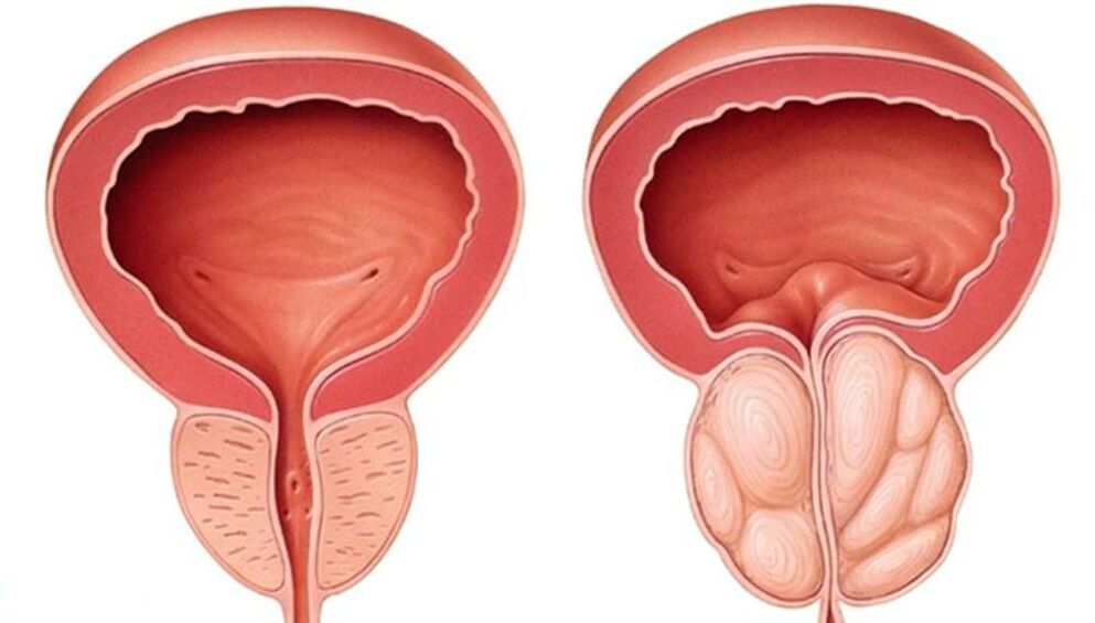 prostate is normal and enlarged