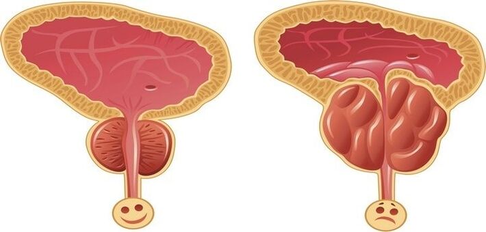 healthy and inflamed prostate