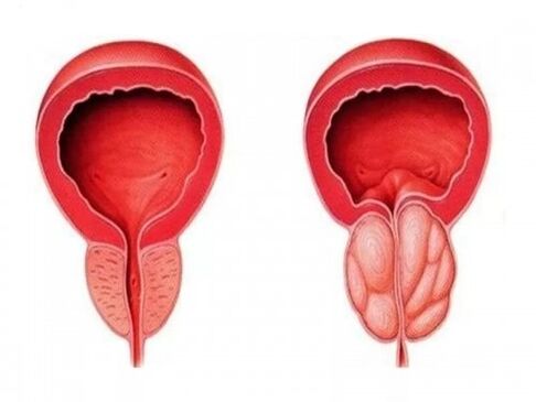 A healthy and inflamed prostate