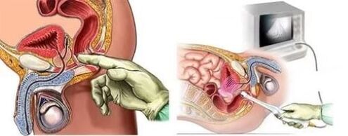 Diagnosis of instrumental prostatitis