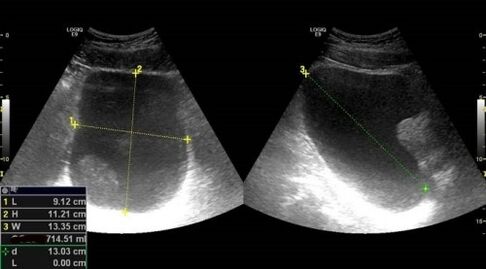 Signs -to prostatitis for ultrasound